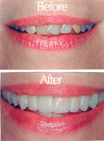 veneers.jpg
